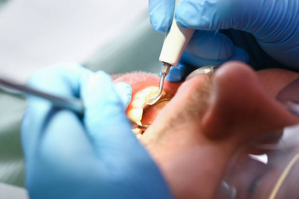 Best Emergency Dental Care for Broken or Chipped Teeth in Hornell, NY
